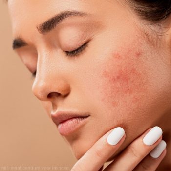 rosacea