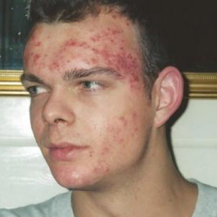 voorbeeld acne