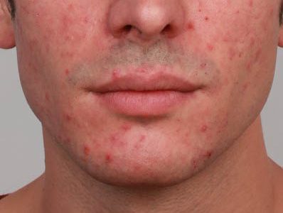 Foto rosacea man