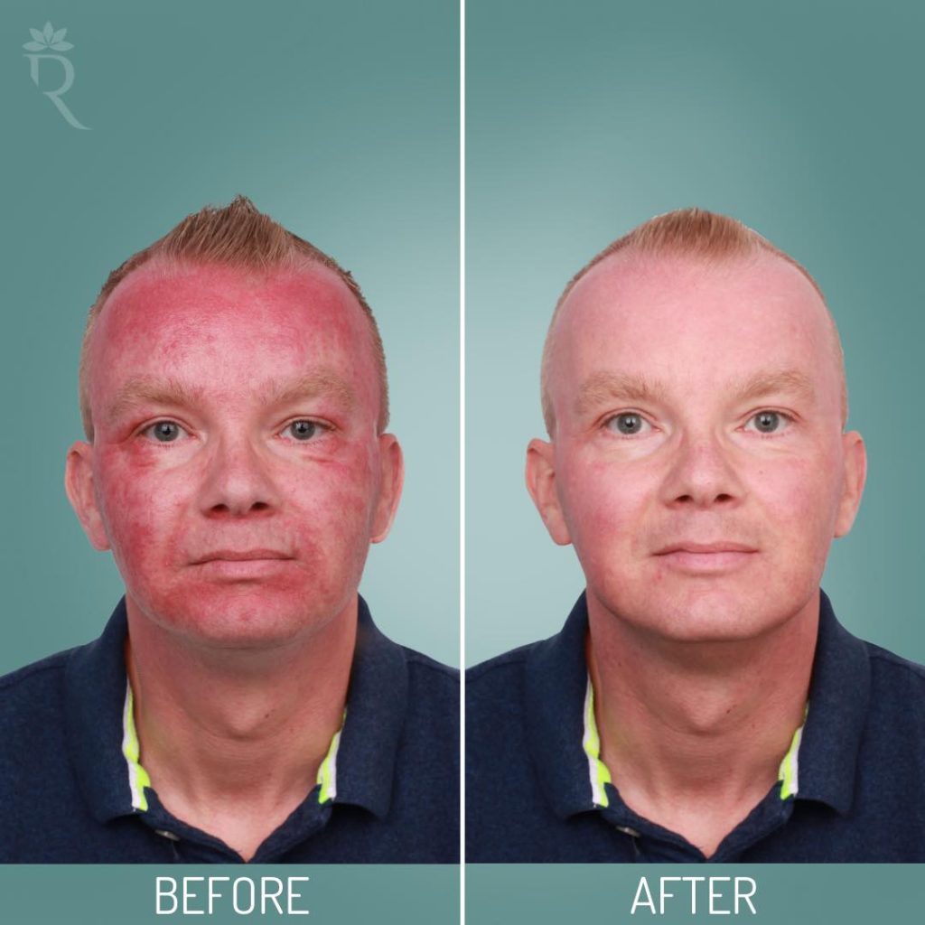 Roodheid in het gezicht rosacea
