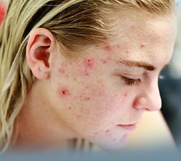 Acne Rosacea by Rositta