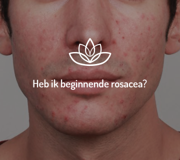 Milde of beginnende rosacea