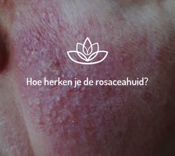 Hoe herken je de rosaceahuid?