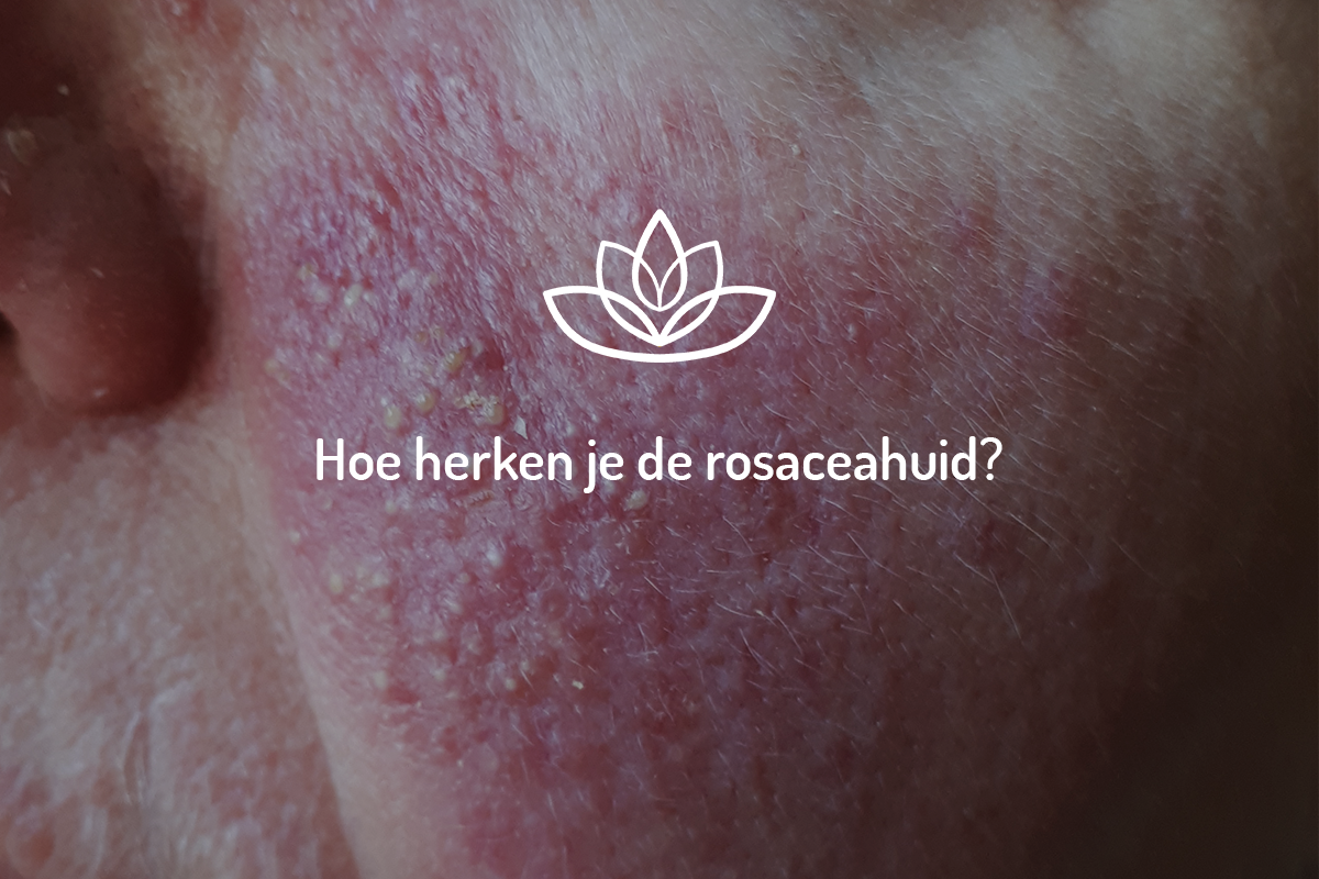 Hoe-herken-je-de-rosaceahuid Hoe herken je de rosaceahuid?
