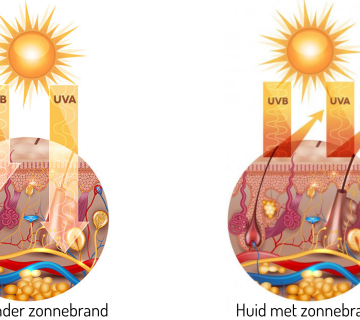 Huid met en zonder zonnebrand