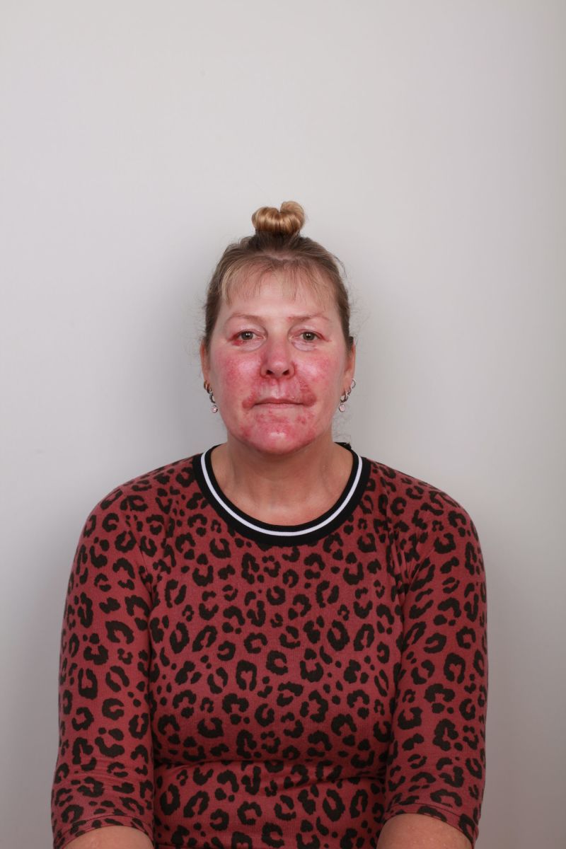 Jedidja met rosacea Jedidja met rosacea