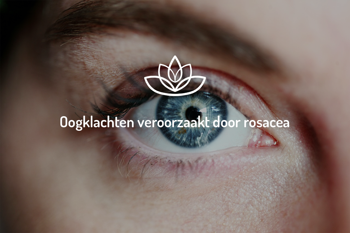 Oogklachten veroorzaakt door rosacea