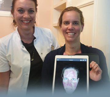 Rosacea