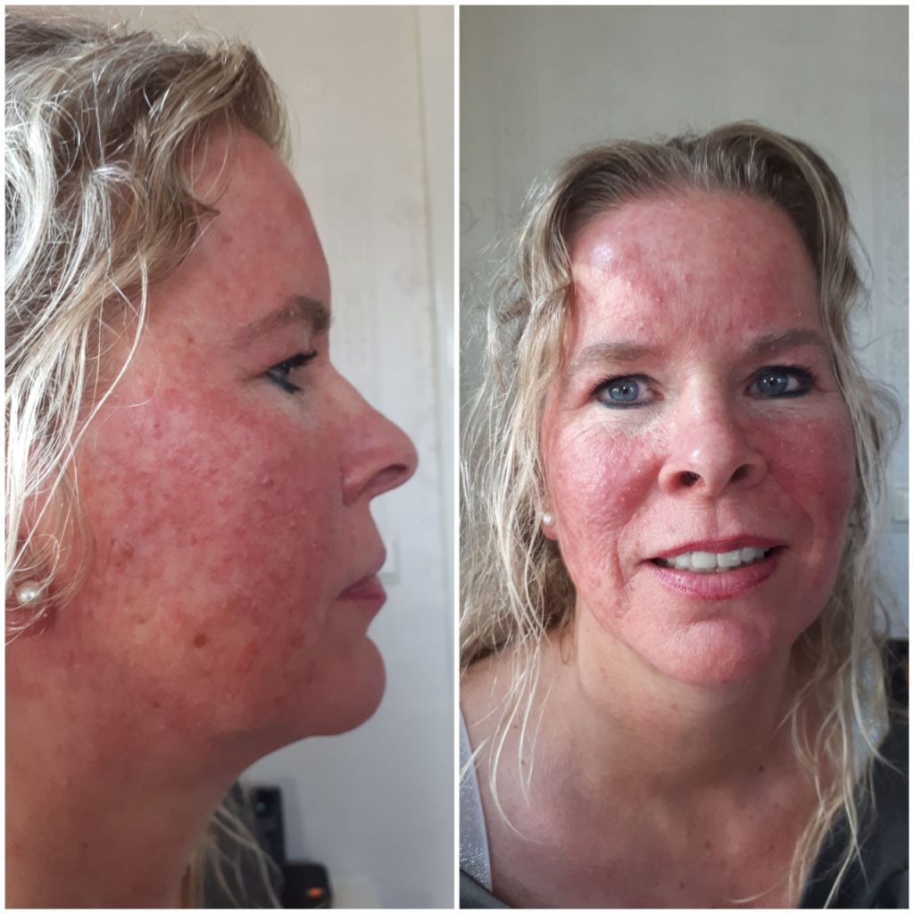 Probleemhuid Rosacea