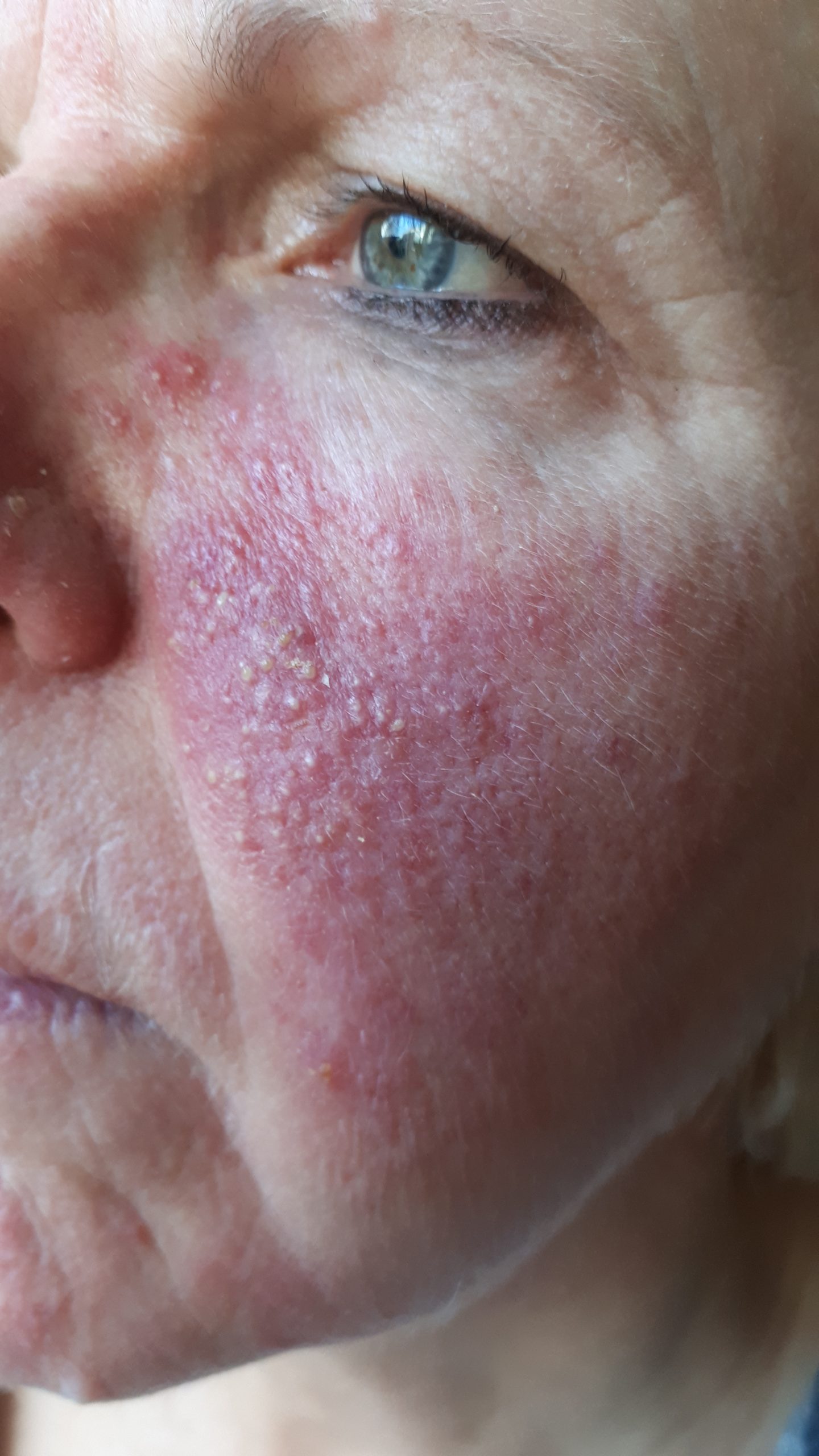 Rosacea wang