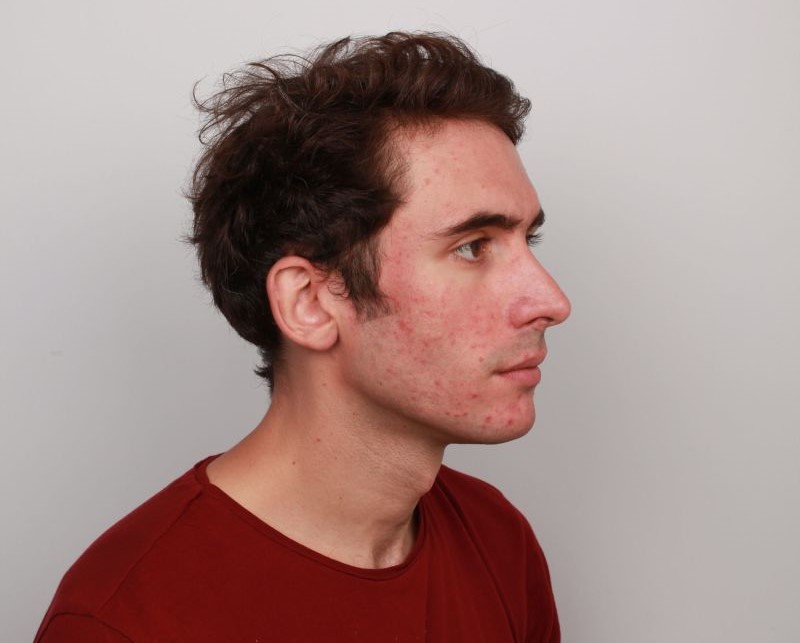 Rosacea before