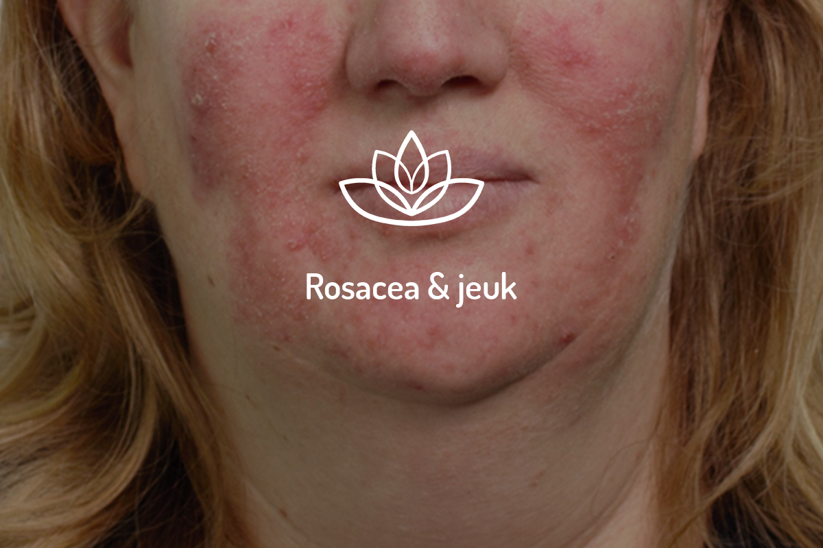 rosacea en jeuk